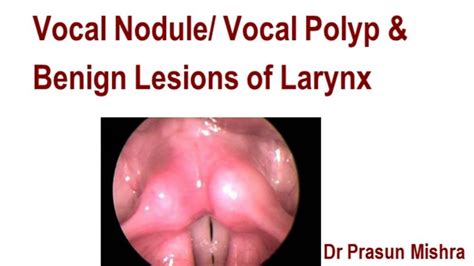 Vocal Nodule Vocal Polyp Benign Lesions Of Larynx My Xxx Hot Girl