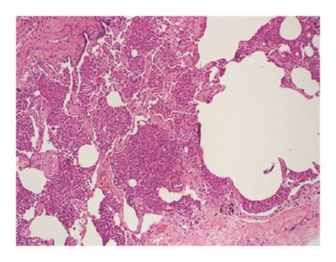 Histopathology Image Of A Rb Ild Specimen Demonstrates Diffuse