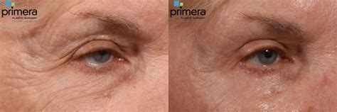 CO Laser Skin Resurfacing With Upper Eyelid Lift
