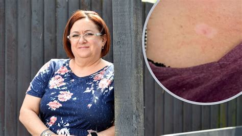 Nurse From Barry Shocked After Small Red Lump On Chest Became Stage