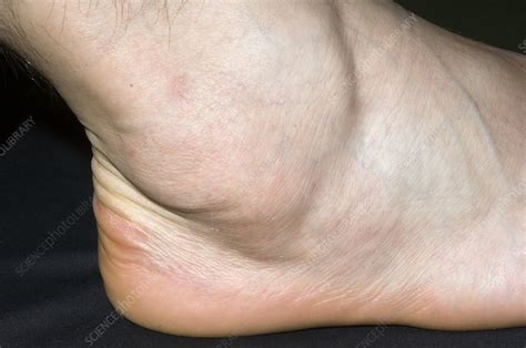 Swollen Ankle Stock Image M3301597 Science Photo Library