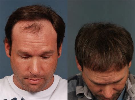 Neograft Hair Transplant Before And After Photos Patient 710 Louisville