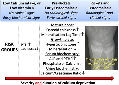 Stages Of Calcium Deprivation Leading To Nutritional Rickets And