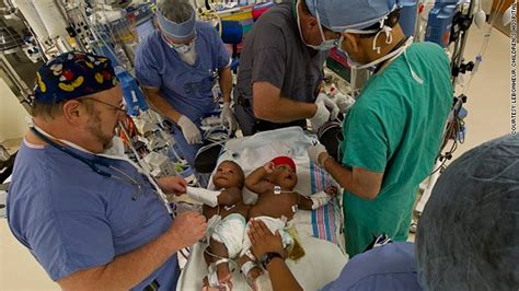 Surgery Separates Twins Joined At Hip The Chart Blogs