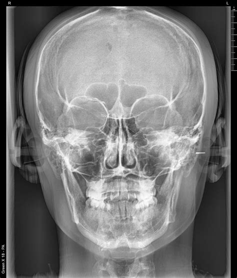 32m Mse Class Iii Malocclusion With A Recessed Jaw Case