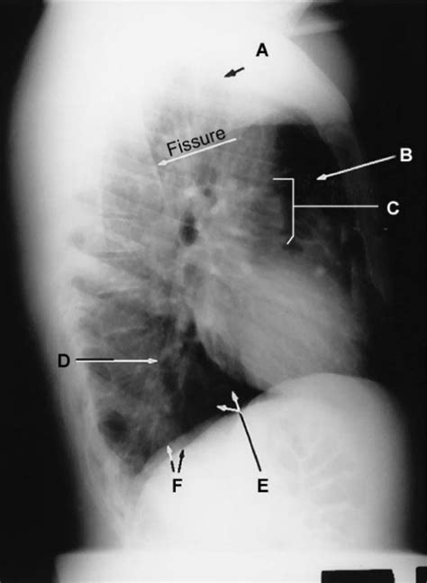 Lateral Chest Radiograph Diagram Quizlet