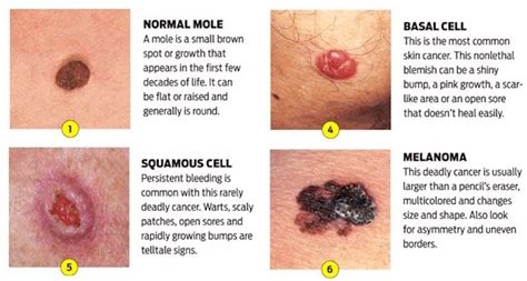 Early detection is the key to treating it. Warning Signs and Symptoms of Non-Melanoma Skin Cancer ...