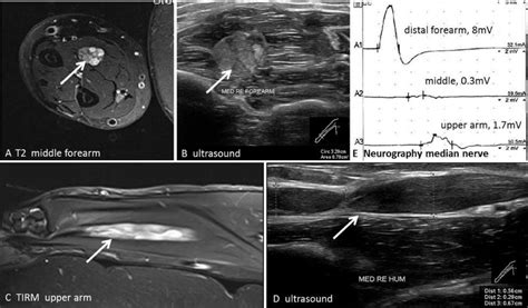 Mri Axial T2 With Fat Suppression A And Ultrasound B Of Median