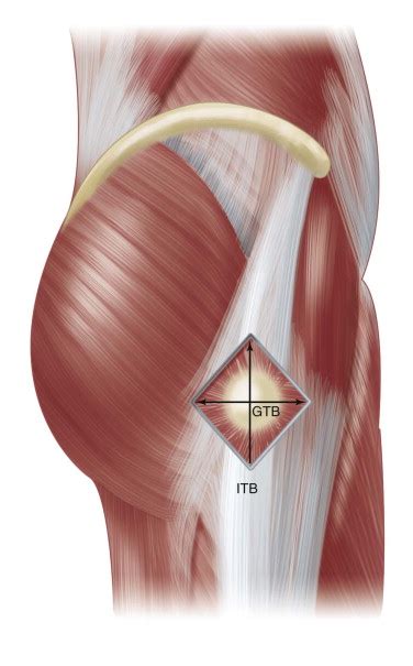Snapping Hip Syndrome Musculoskeletal Key