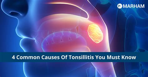 4 Common Causes Of Tonsillitis You Must Know Marham