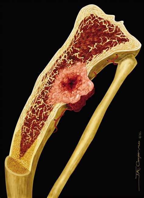 Paget Disease Of Bone Radiographics
