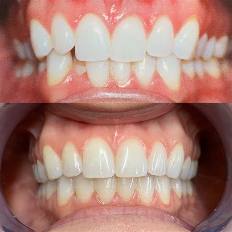 Invisalign Before And After Firouz Orthodontics West Los Angeles