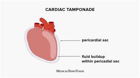 Cardiac Tamponade Causes Symptoms And Treatment