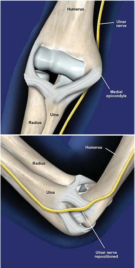 Ulnar Nerve Transposition At The Elbow Central Coast Orthopedic