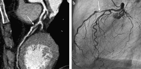 Low Dose Slice Dual Source Ct Coronary Angiography Accuracy And