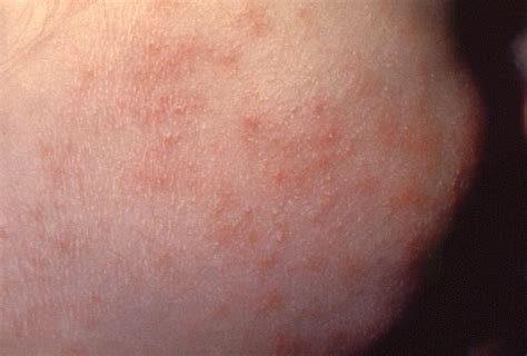 Tiny Pinpoint Red Dots On Skin Causes By Viruses Nipoddate