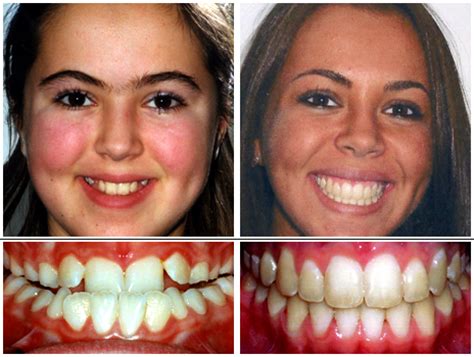 Apply a step 2 neutralizer pad to the face after 10 minutes, or sooner if you experience bothersome redness or discomfort. Before and After - dk orthodontics | Caldwell Parsippany NJ