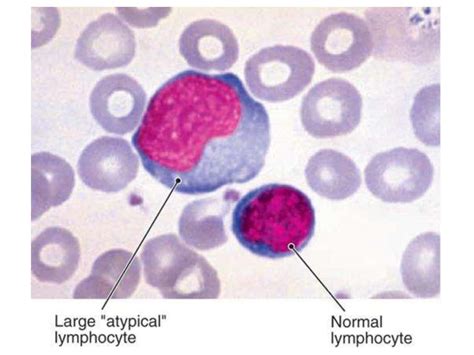 Infectious Mononucleosis Pictures
