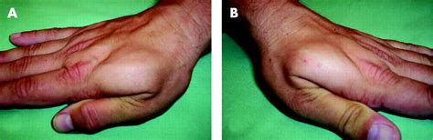 Bilateral Idiopathic Hypertrophy Of The First Dorsal Interosseous