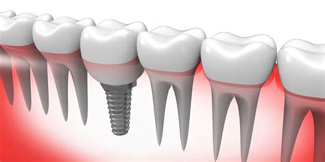 Single Tooth Dental Implants Bayside Periodontics And Dental Implants