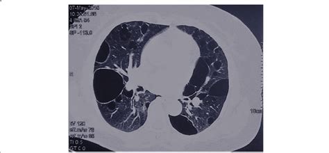 Chest Ct Showing Multiple Thin Walled Cysts In Patient B24 Download