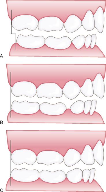 Then a characteristic step is formed. 27: Managing the Developing Occlusion | Pocket Dentistry