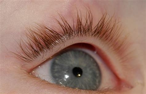 Trichiasis Ingrowing Eyelashes Bopss
