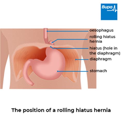 Hiatus Hernia Bupa Uk Symptoms And Treatment