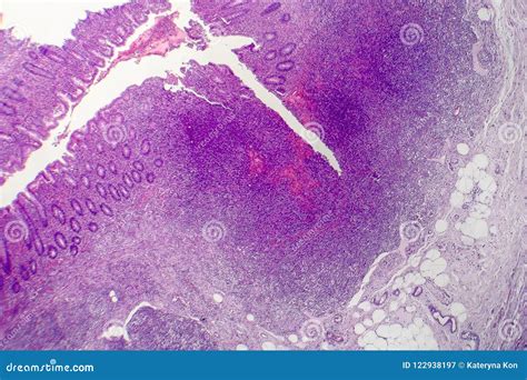 Suppurative Appendicitis Light Micrograph Stock Image Image Of