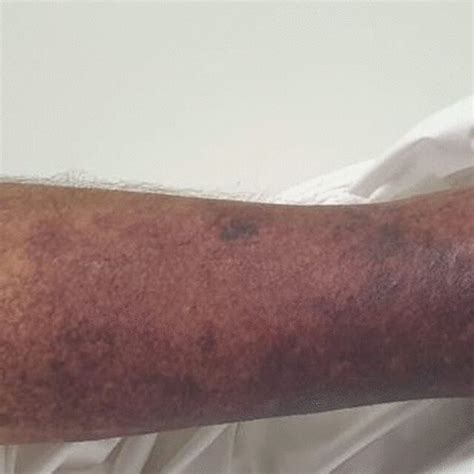 Left Lower Extremity Violaceous Discoloration At Presentation