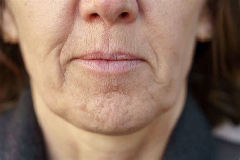 Fine Lines And Wrinkles Face And Skin Concerns Vie Aesthetics