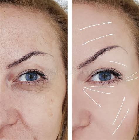 Woman Wrinkles Skin Treatment Before And After Dermatology Procedures