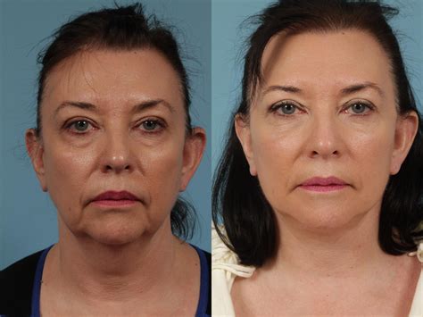 The firm engages in the provision of telecommunications, information, and technology services. Facelift/Minilift Before & After Photos Patient 329 ...