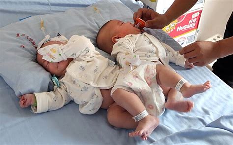 Doctors Separate Conjoined Twins With Help Of 3d Printer