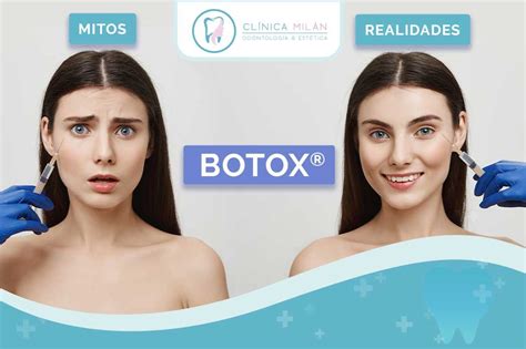 Mitos Y Realidades Del Botox Cl Nica Mil N Odontolog A Est Tica