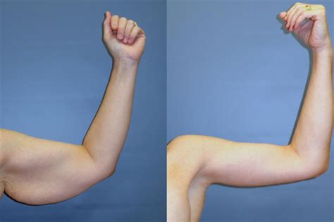 Arm Lift Brachioplasty Cosmetic Surgery