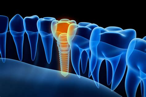 Benefits Of Guided Implant Surgery Lincoln Ne The Benefits Of Gui