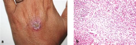 Neutrophilic Dermatosis On The Dorsum Of The Patients Left Hand