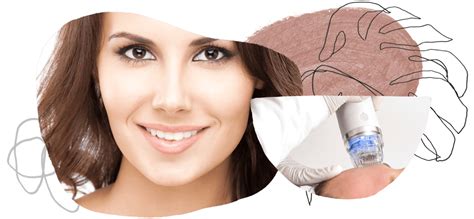 Secret RF Micro-Needling - Skin Clinic Blyss