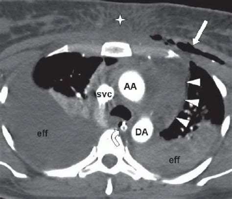 Mediastinal Hematoma Radiology Key