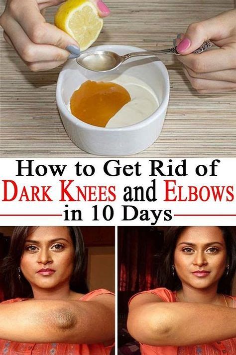 How To Get Rid Of Dark Elbows And Knees In 10 Days Dark Elbows