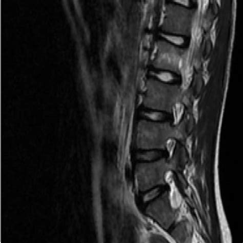 Spine Mri After Treatment Complete Disappearance Of Both D12 Lesion