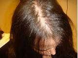 Alopecia Doctor Images