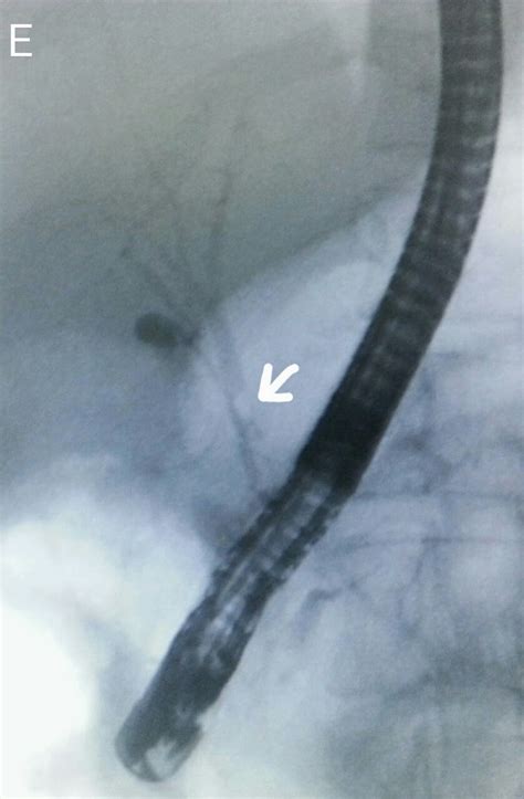 Ercp And Egd Follow Up Cbd Clearance After Initial Clearing Of