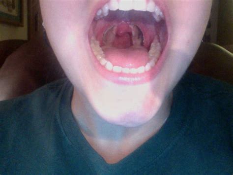 Tonsillectomy Scabs Pictures