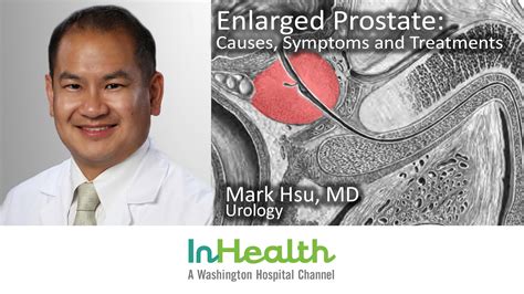 Enlarged Prostate Causes Symptoms And Treatment Washington Hospital Healthcare System
