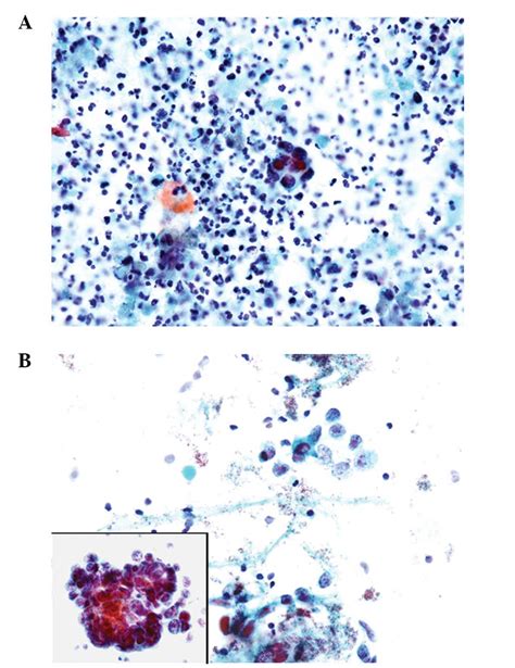 Prostate Biopsy Gleason Score 9 Small Cell Carcinoma Prostate A Case