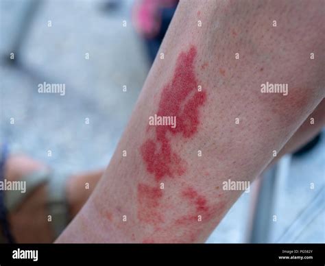 Inflammation Blood Vessels Hi Res Stock Photography And Images Alamy