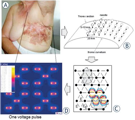 Chest Wall Recurrence From Breast Cancer And Development Of The Grid