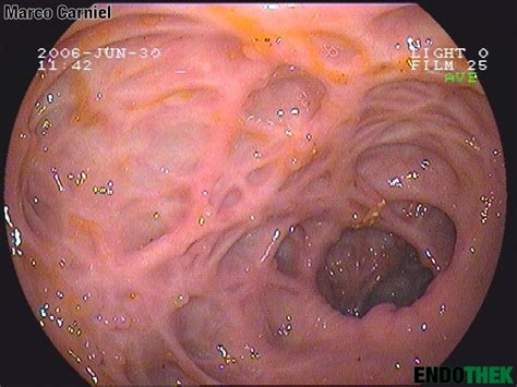 It passes upward, from its commencement at the cecum, opposite the colic valve, to the. Colitis ulcerosa - Endothek